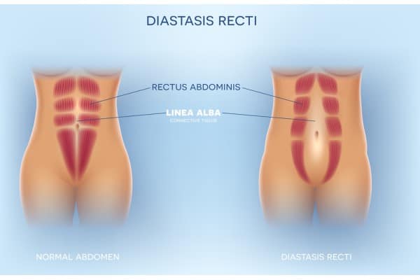 What Non-Surgical Options Are Available for Diastasis Recti Heath?