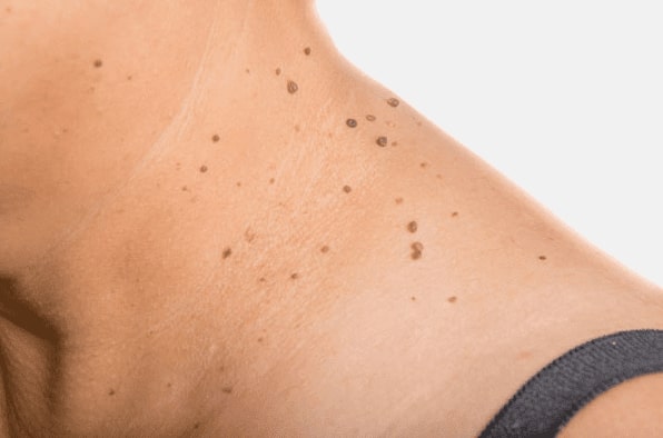 Are you looking for easy skin tag removal Heath - then contact Spire today!