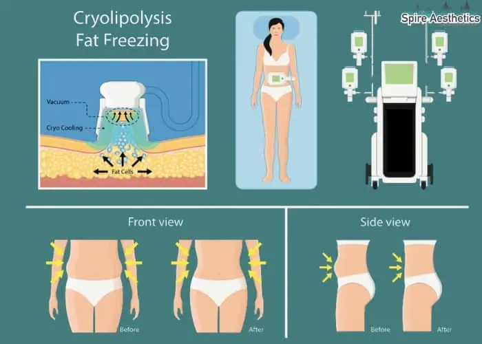 Fat freezing treatment Heath benefits for competitions to remove stubborn fat deposits.