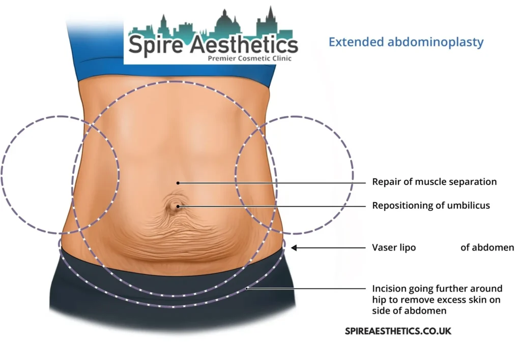 Understanding Loose Skin After Gastric Band Heath Surgery and HIFU Treatment