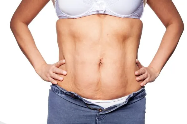sagging skin on woman's stomach after weight loss injections Heath