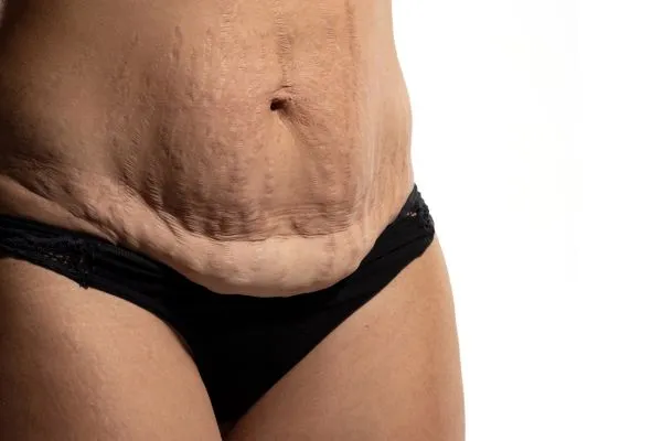 Image of womans stomach after weight loss injections Heath showing saggy skin